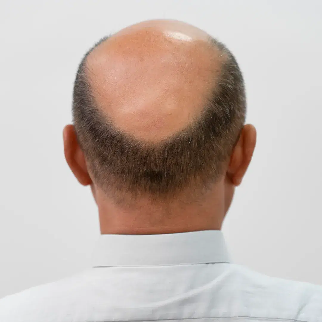 Donor Area: All You Need to Know Before a Hair Transplant