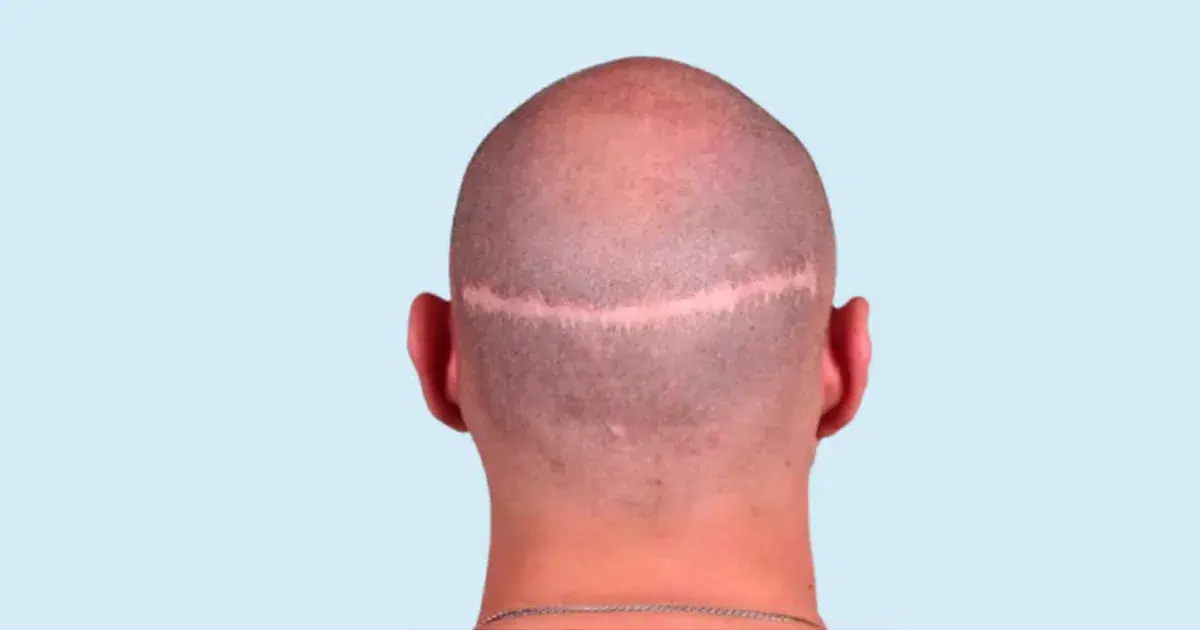 FUT Hair Transplant Cost, Procedure, and What to Expect