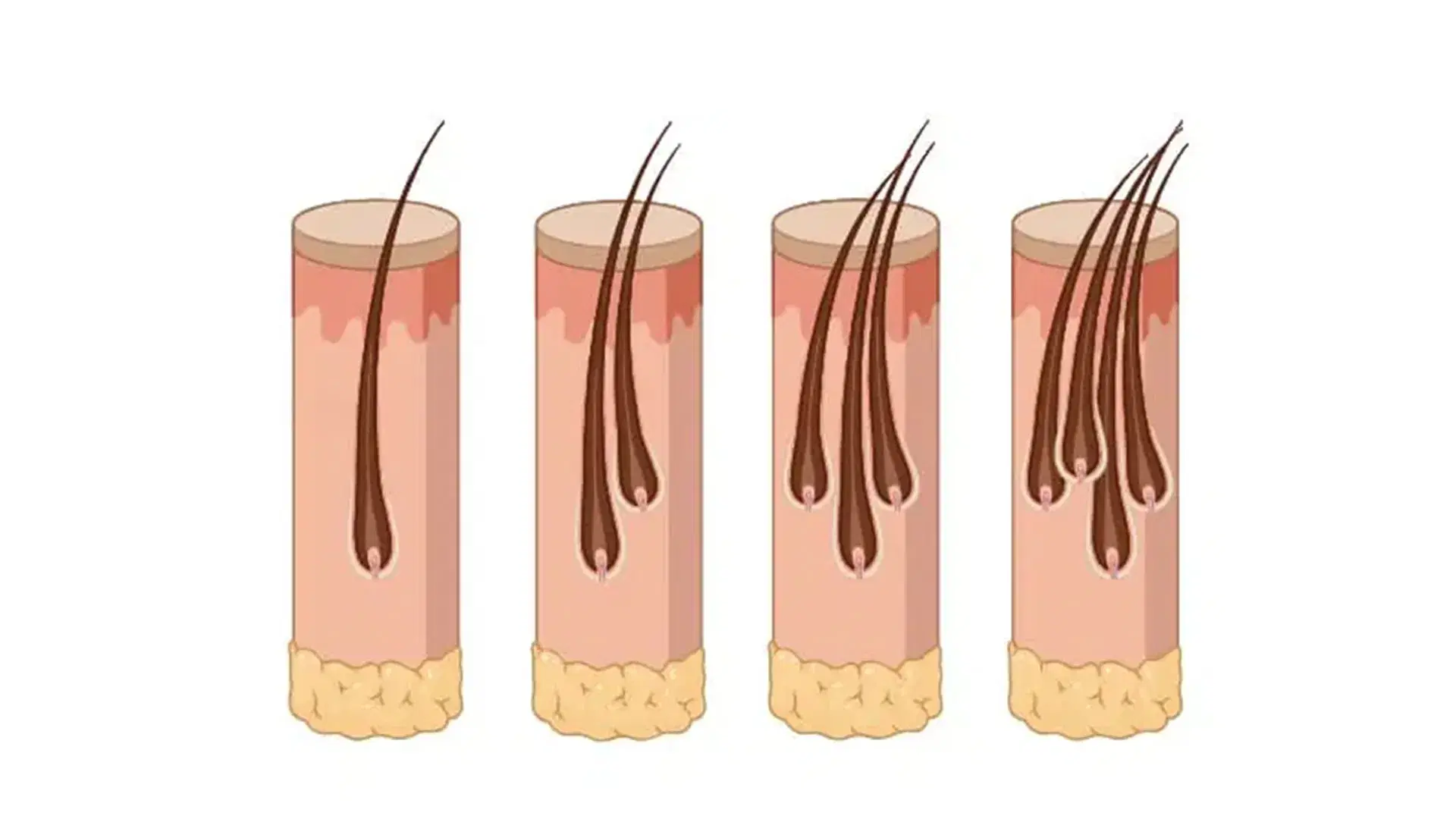 Grafts for Hair Transplant by Baldness Stage
