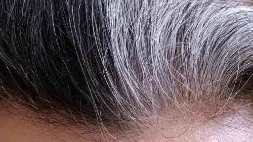 Grey Hair Transplant: Can Grey or White Hair Be Transplanted?