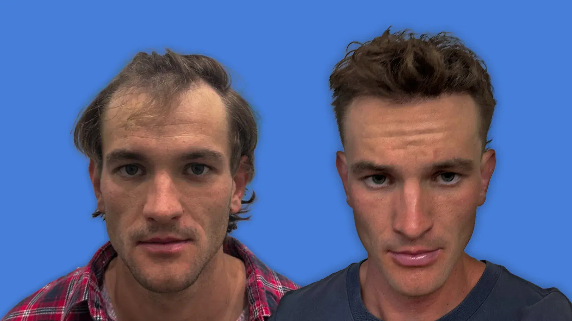 Hair Graft Results: What to Expect Before and After a Transplant