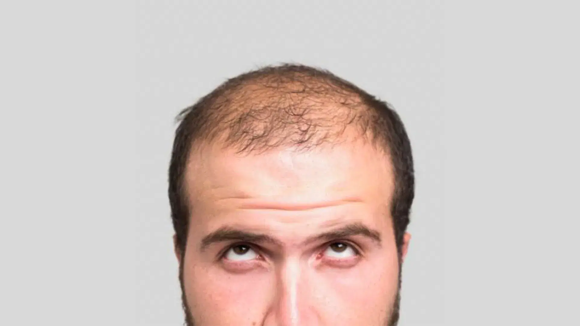 Hair Grafts Falling Out: Should You Worry?