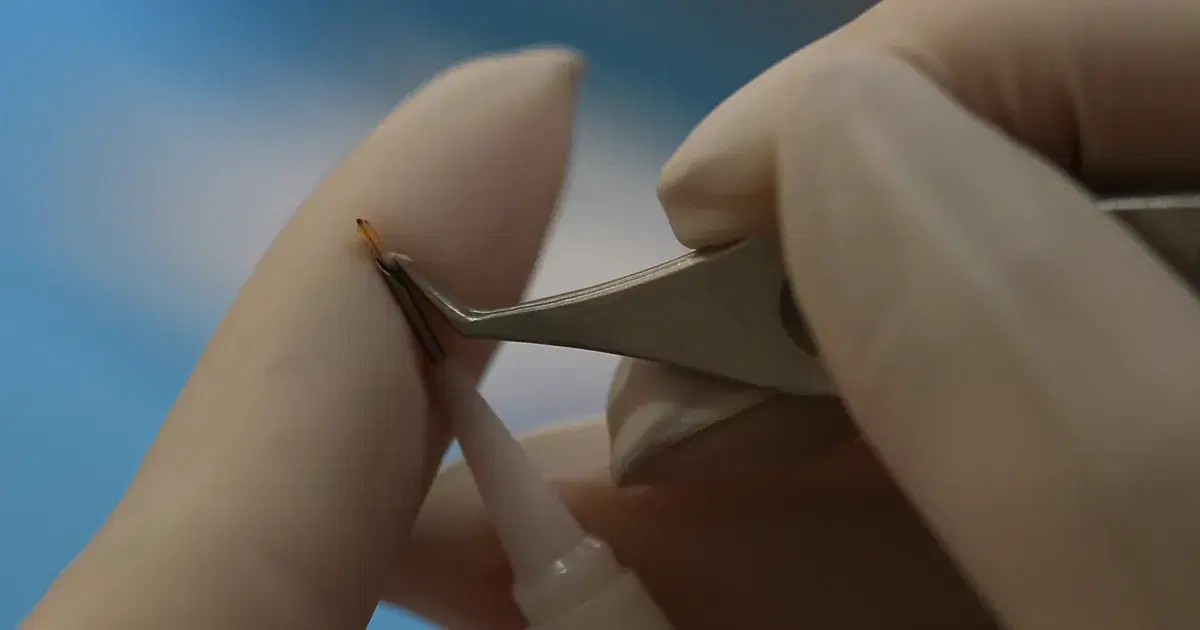 Hair Grafts: Cost, Numbers, and Results in Transplants