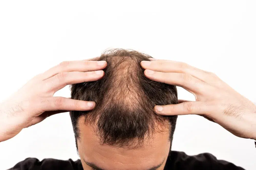 Hair Loss After Ozempic, Wegovy or Mounjaro