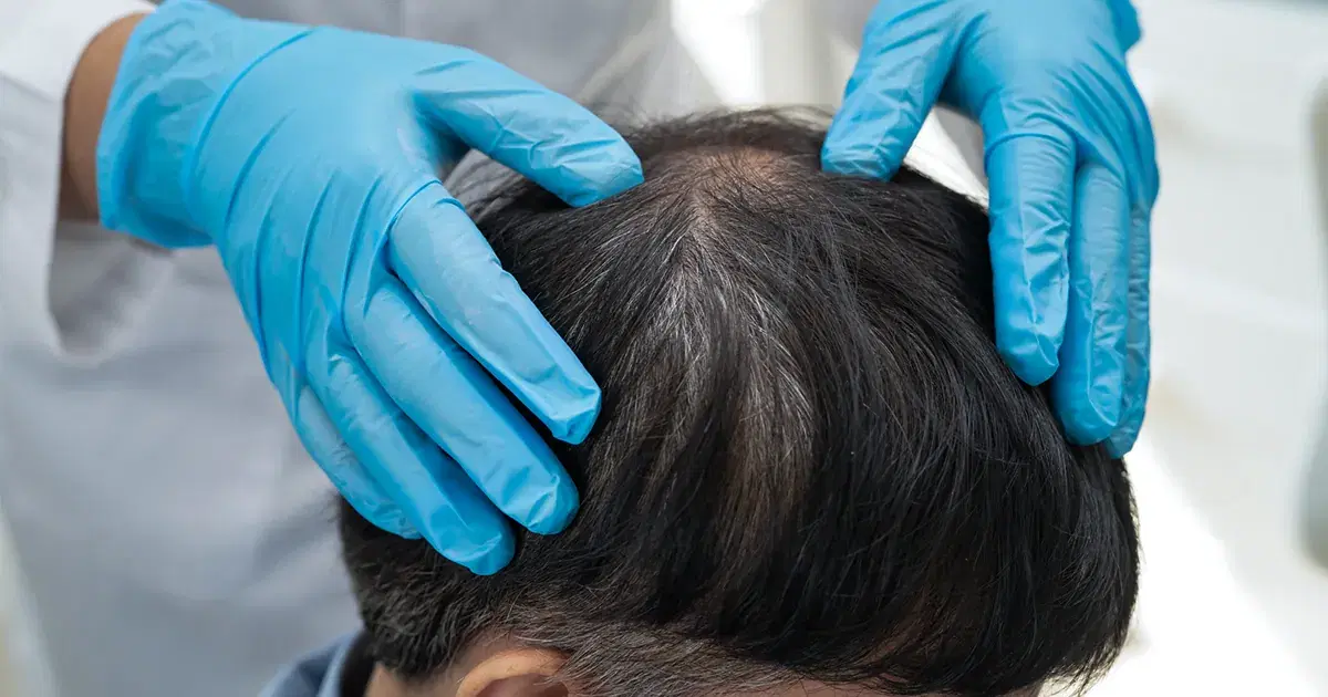 Hair Plugs: The First Step in Surgical Hair Restoration