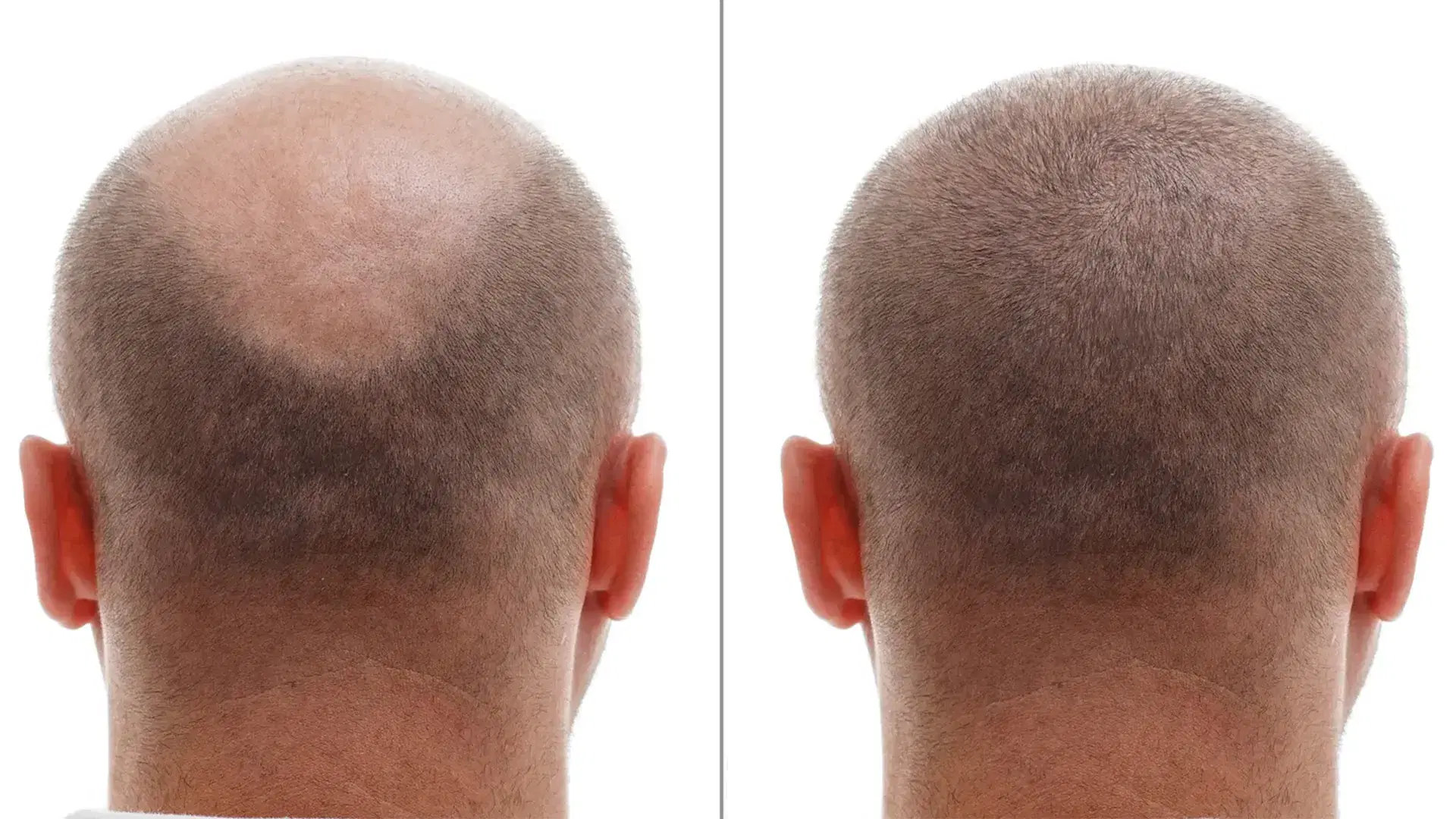 Hair Transplant Donor Area Recovery: A Week-by-Week Timeline