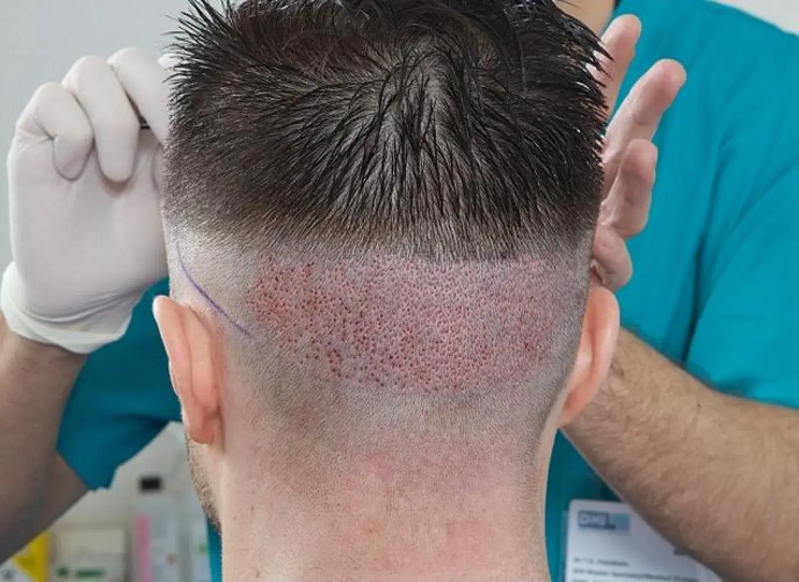 Hair Transplant Infection: Symptoms and Prevention