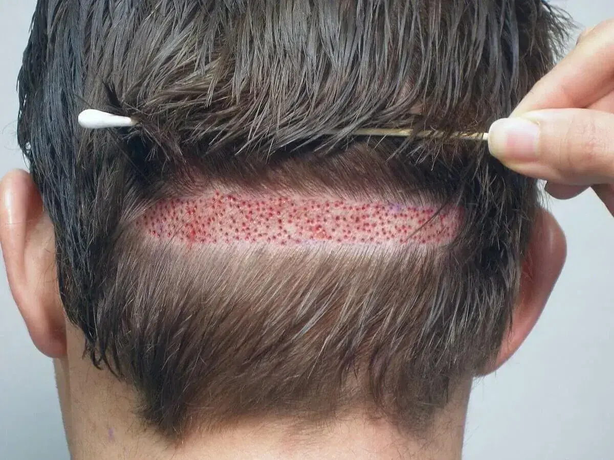 Hair Transplant Strip Method Explained