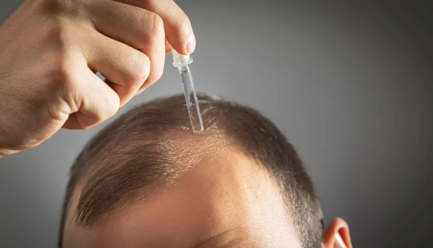 Hair Transplant Without Finasteride or Minoxidil: Can It Still Work?