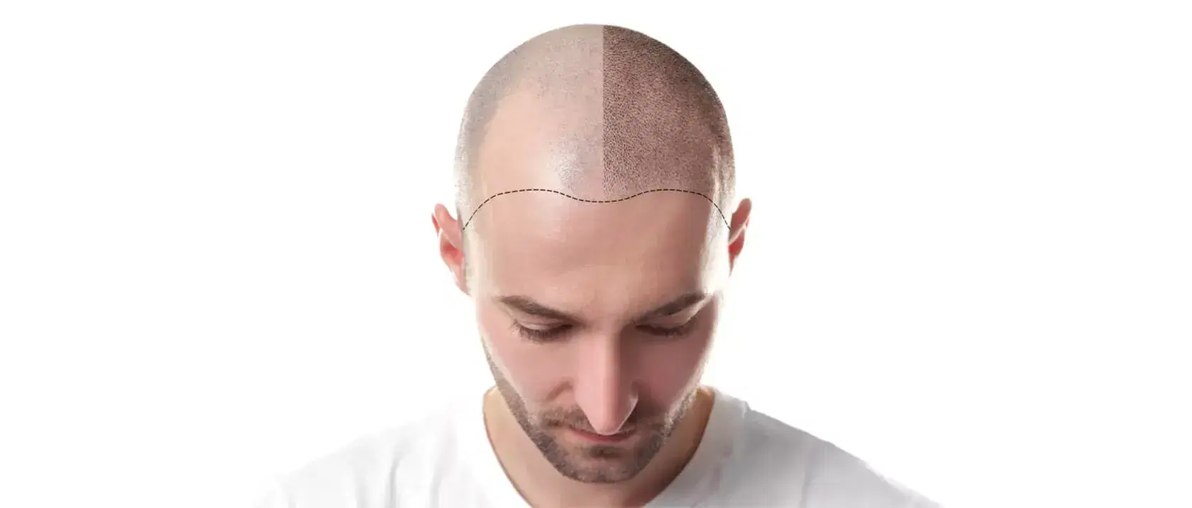 Hair Transplant Zones: Frontal, Crown, Fringe