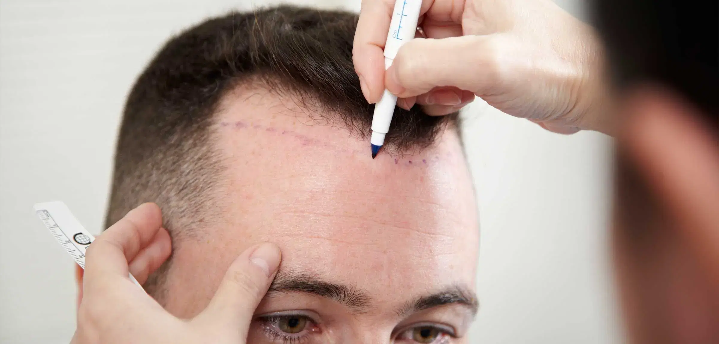 How Natural Can a Front Hairline Look After a Hair Transplant?