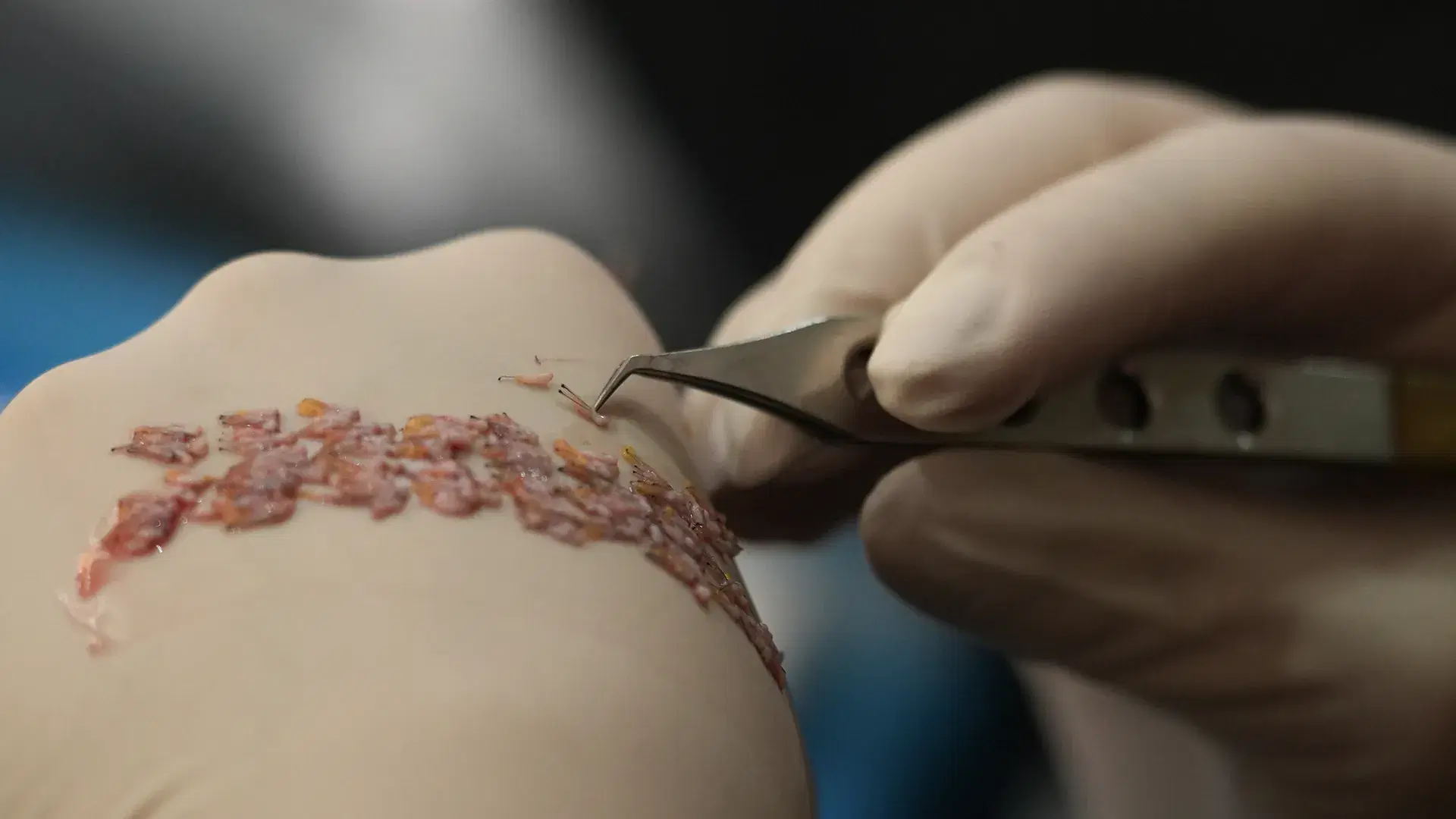 How Do Hair Grafts Work in a Transplant?