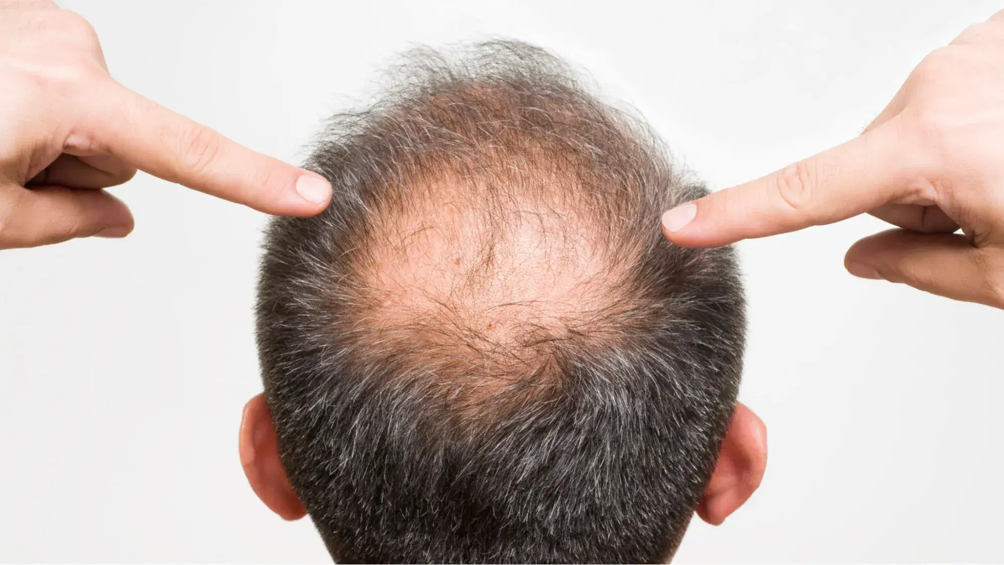 How To Regrow Hair On Bald Spot?