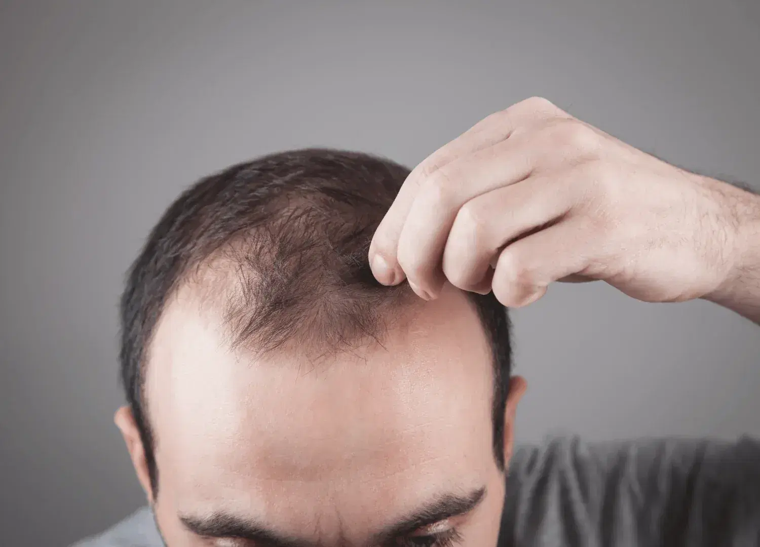 Hair Transplant Surgery for Male Pattern Baldness Treatment