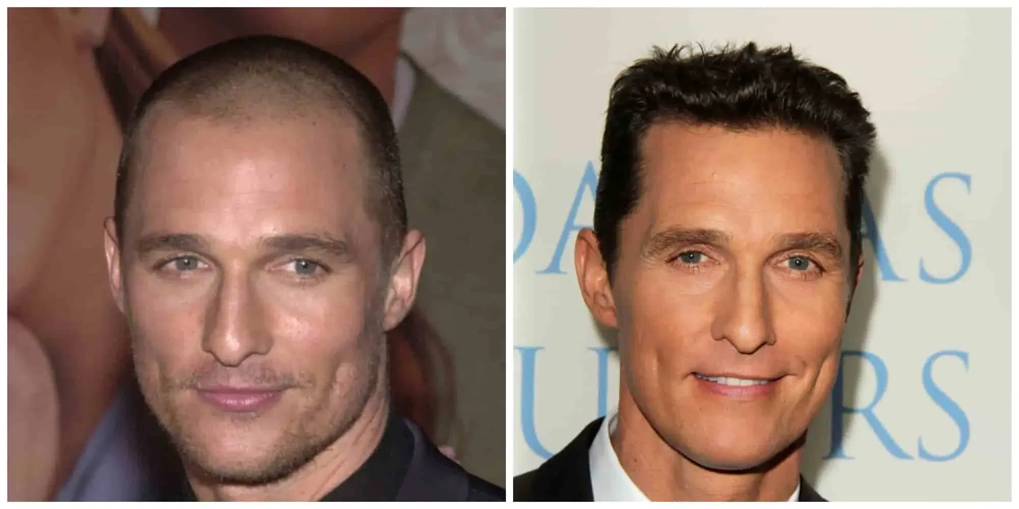 How Matthew McConaughey Got His Hair Back?