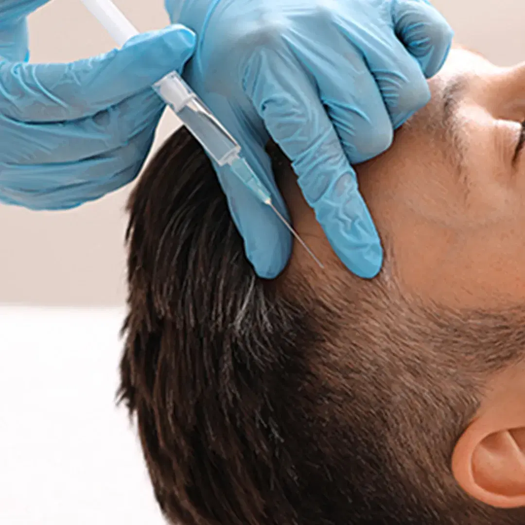 Mesotherapy for Hair: Revive Your Scalp and Strengthen Growth