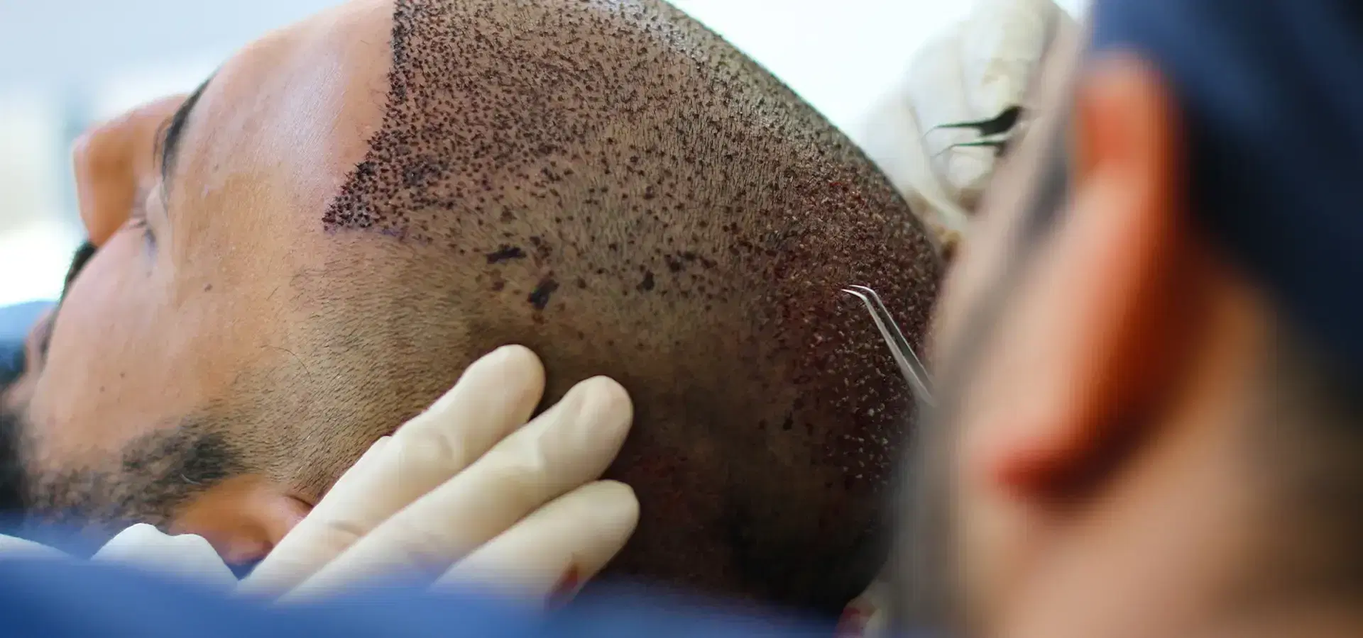 Micro FUE vs Regular FUE: What Is the Difference?