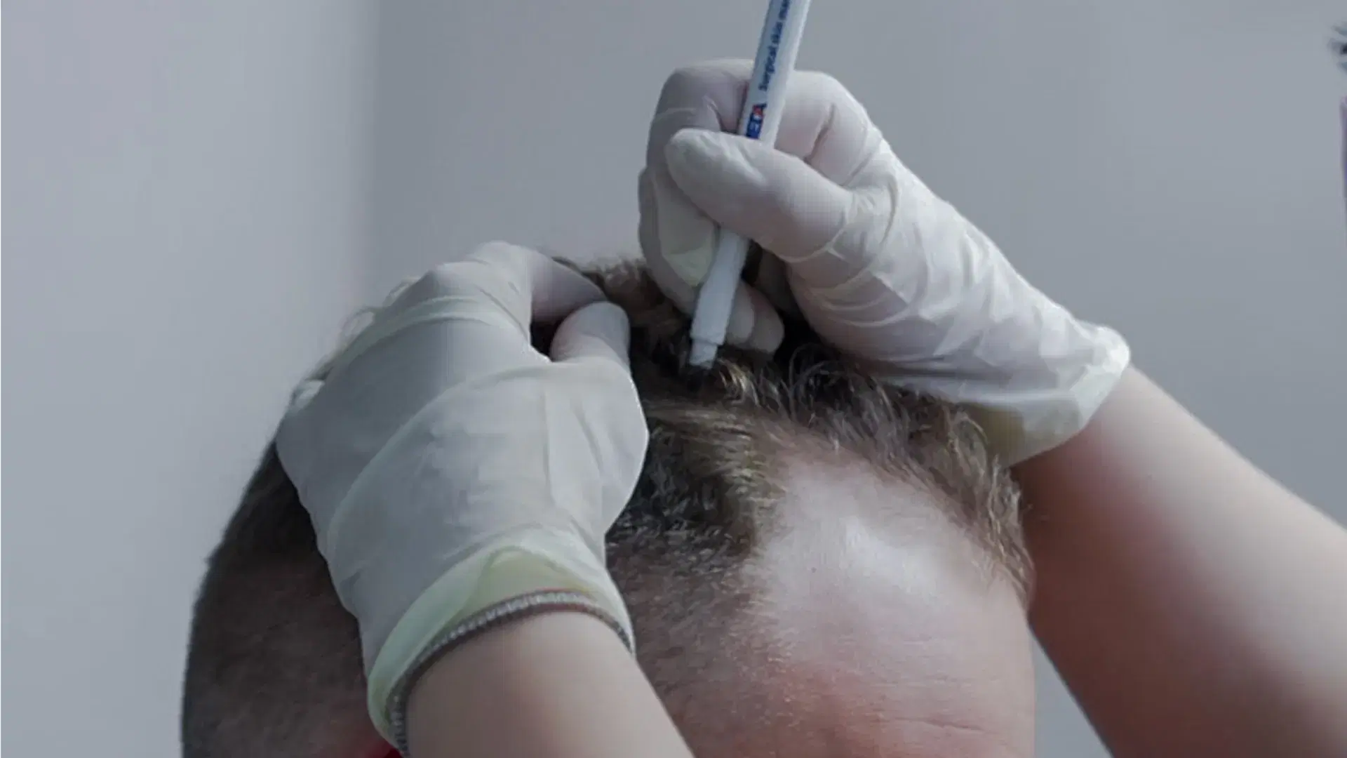 Natural Results and Hairline Design