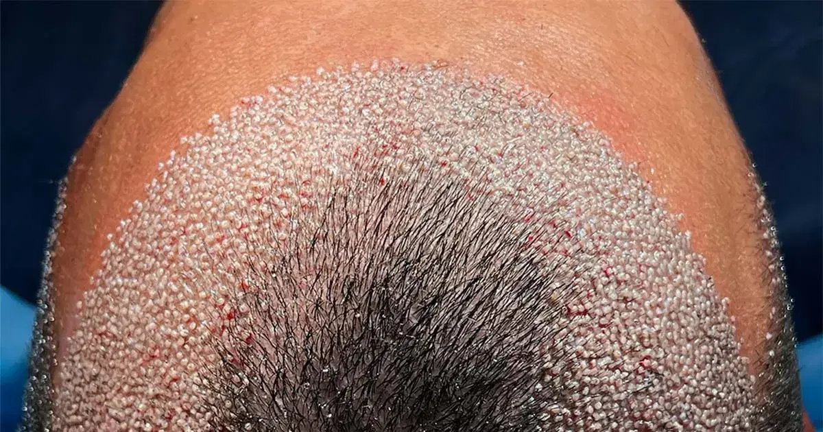 Benefits of No Shave Hair Transplant with DHI