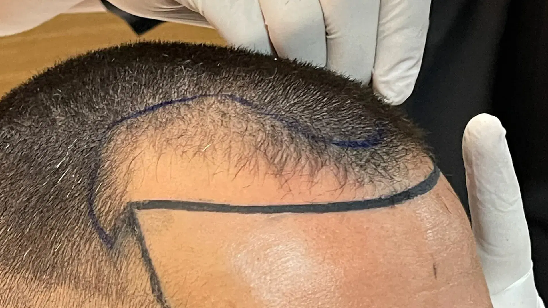 No Shave Hair Transplant in Turkey