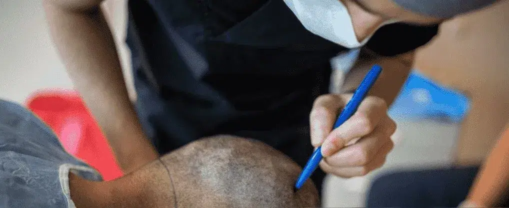 Overharvesting in Hair Transplants: Signs and Treatment