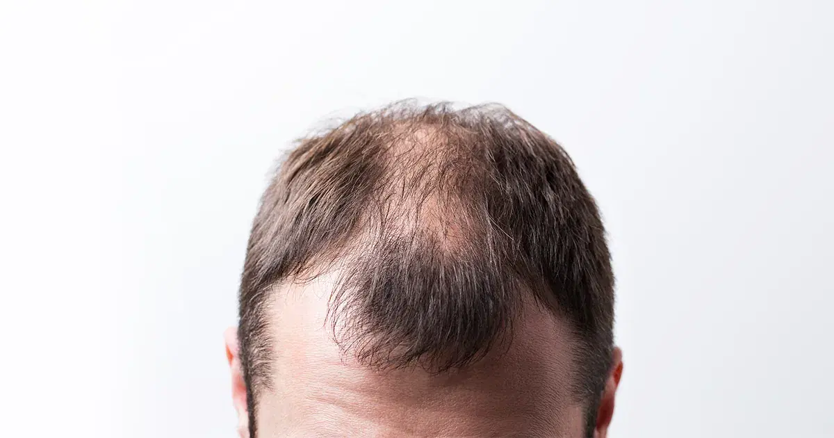 Pattern Baldness (Androgenetic Alopecia) in Men and Women