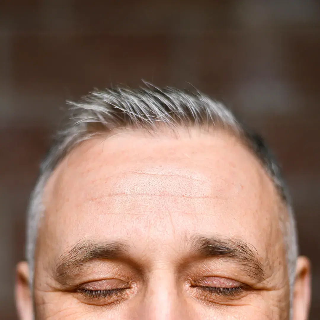 Receding Hairline: Causes, Styles, and Solutions