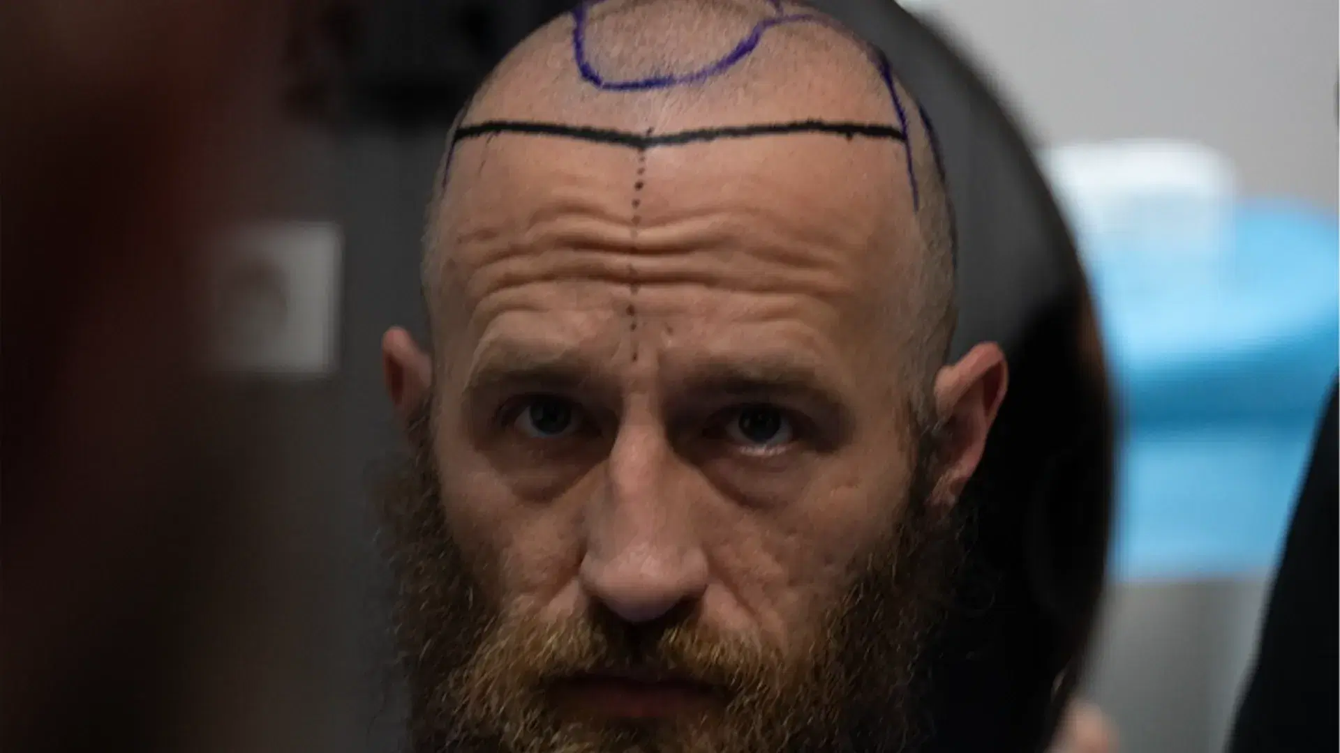 Sapphire FUE Hair Transplant for Hairline Design