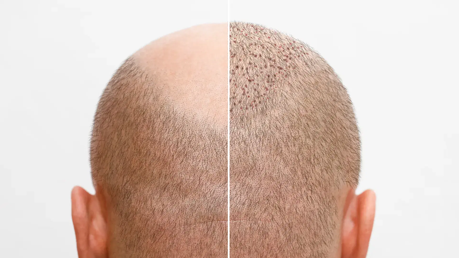 Shock Loss and Overharvesting in the Donor Area