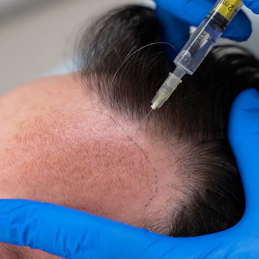Stem Cell Therapy for Hair: Revitalize Your Hair Naturally