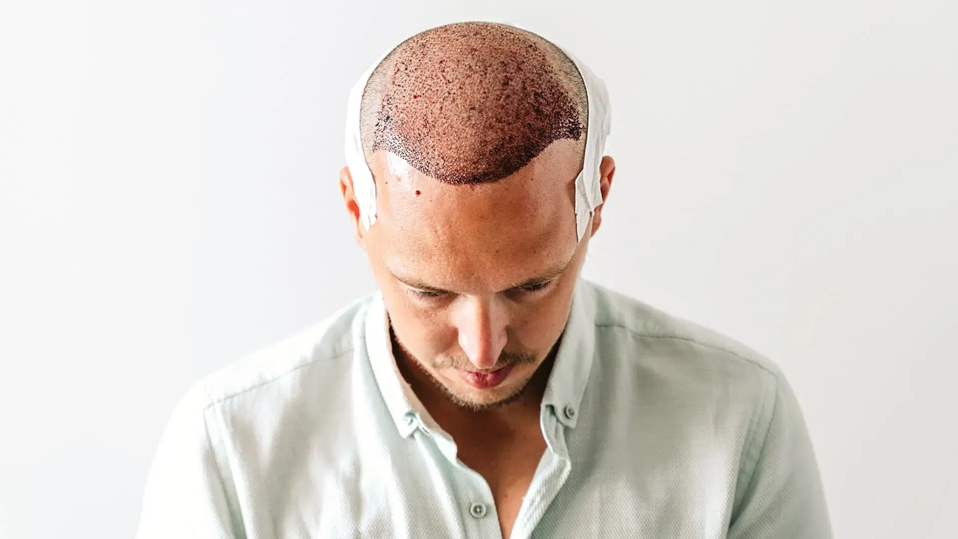 Swelling After Hair Transplant: Causes and Recovery