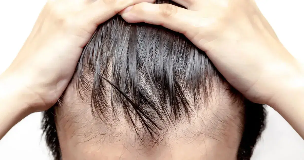 Telogen Effluvium: Causes, Symptoms, and Recovery Guide