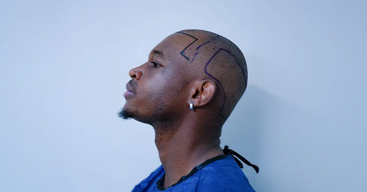 The Best Donor Area for Hair Transplant