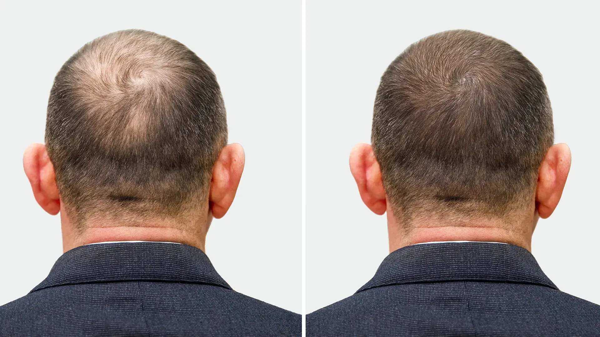 Treatments to Boost Hair Growth