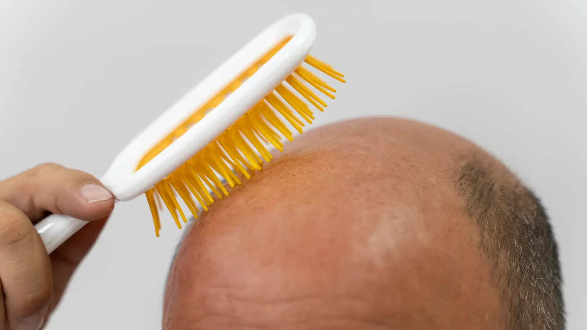 What Does Thyroid Hair Loss Look Like?