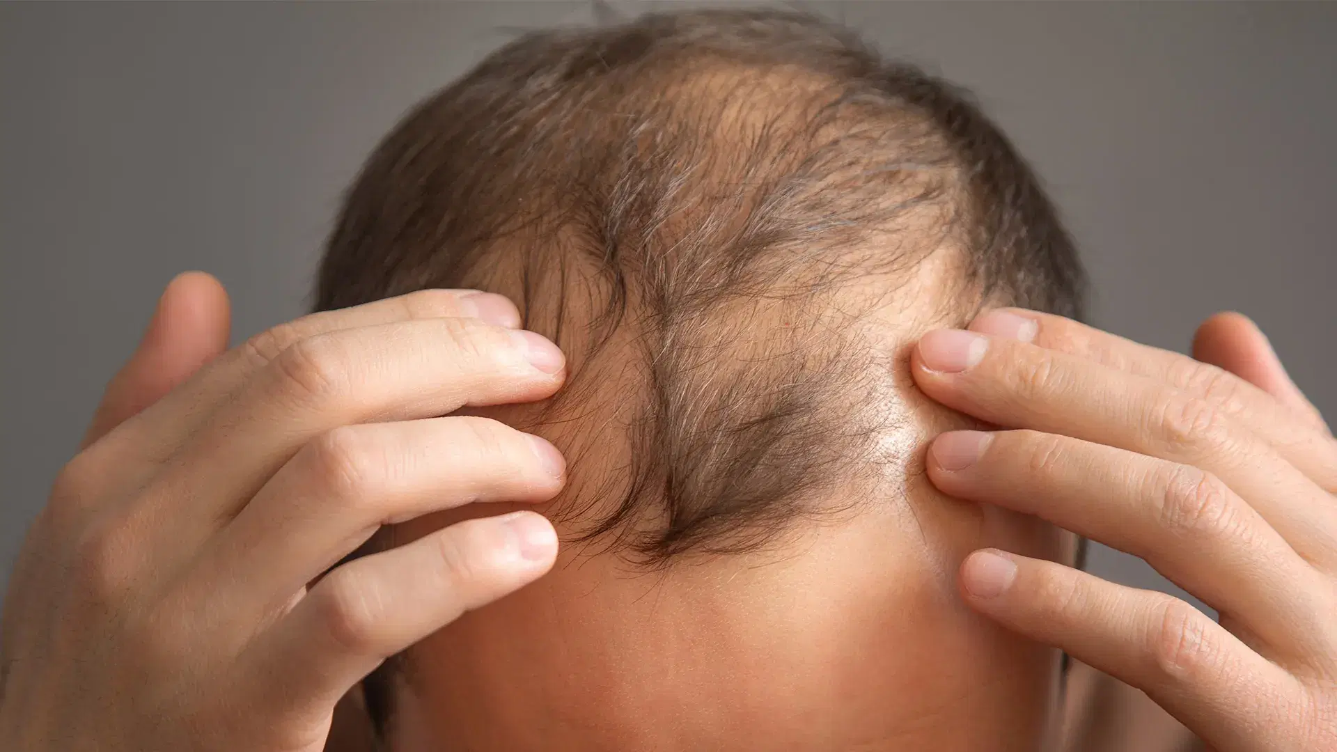 What Is DHT Blocker and How Does It help Hair Loss?