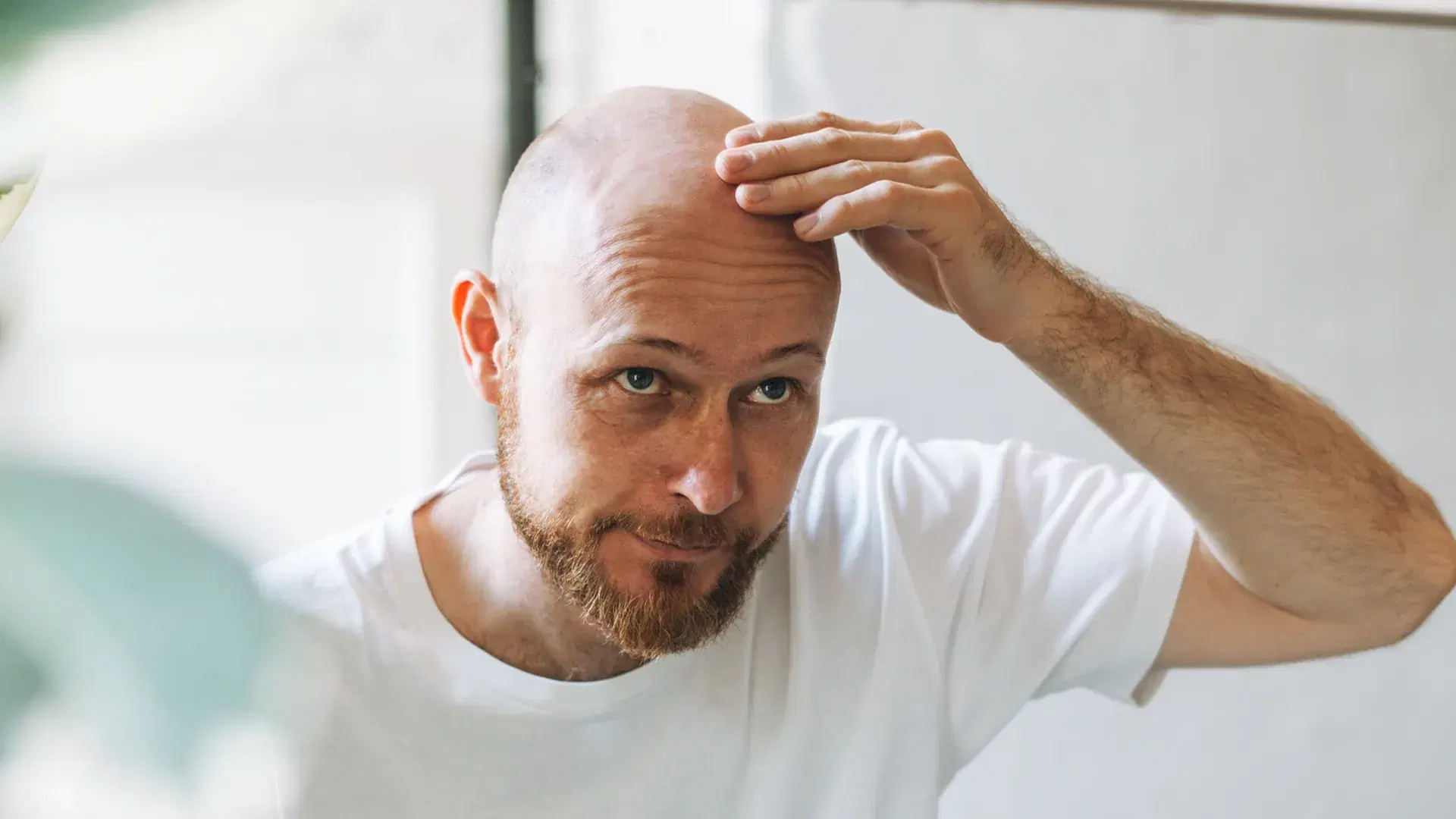 What Is Thyroid Hair Loss and How Does It Happen?