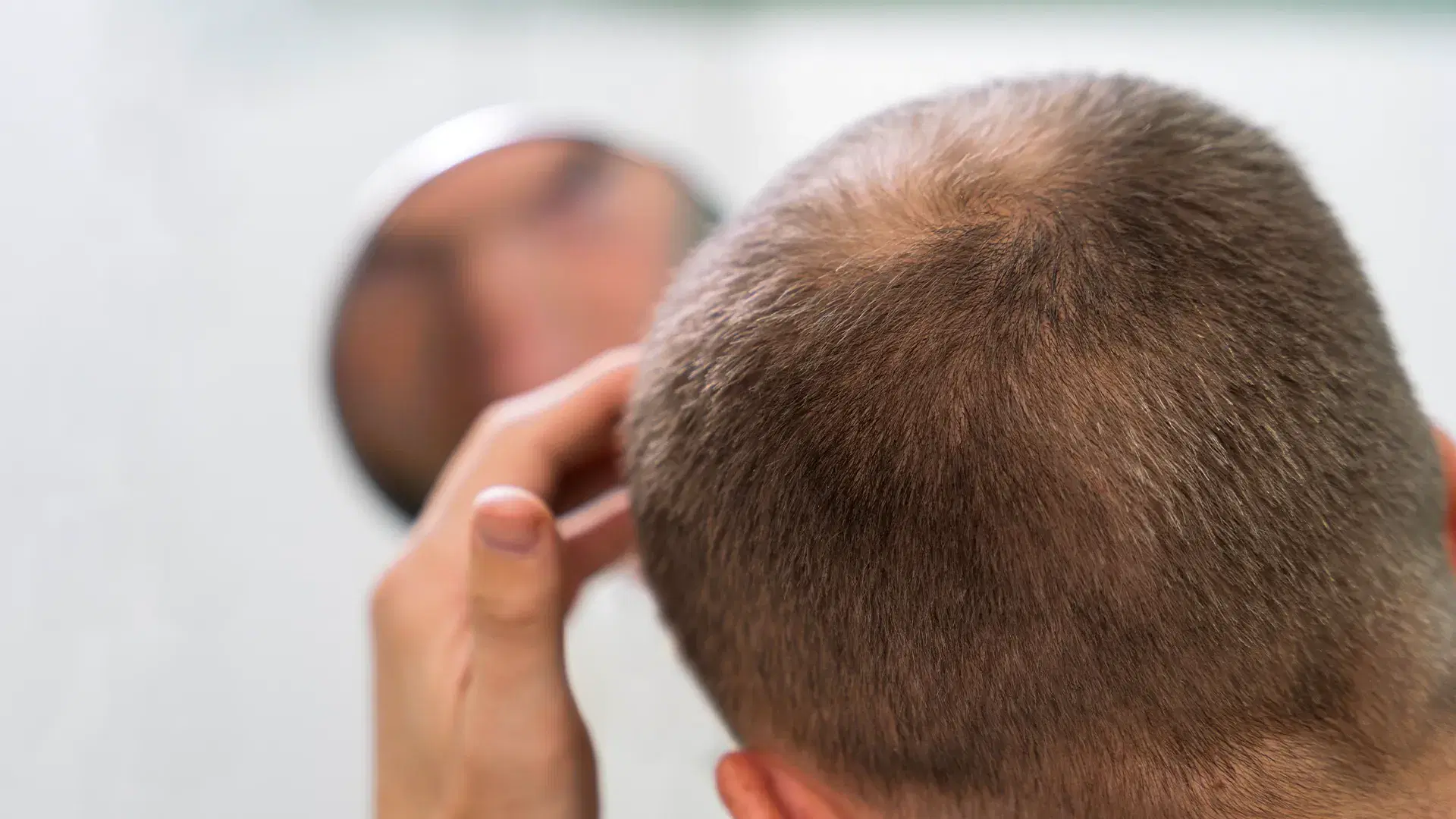 Who Is a Good Candidate for Mesotherapy for Hair