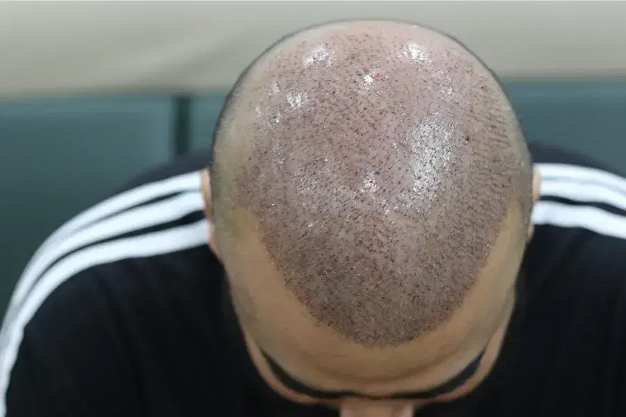 Bad Hair Transplant