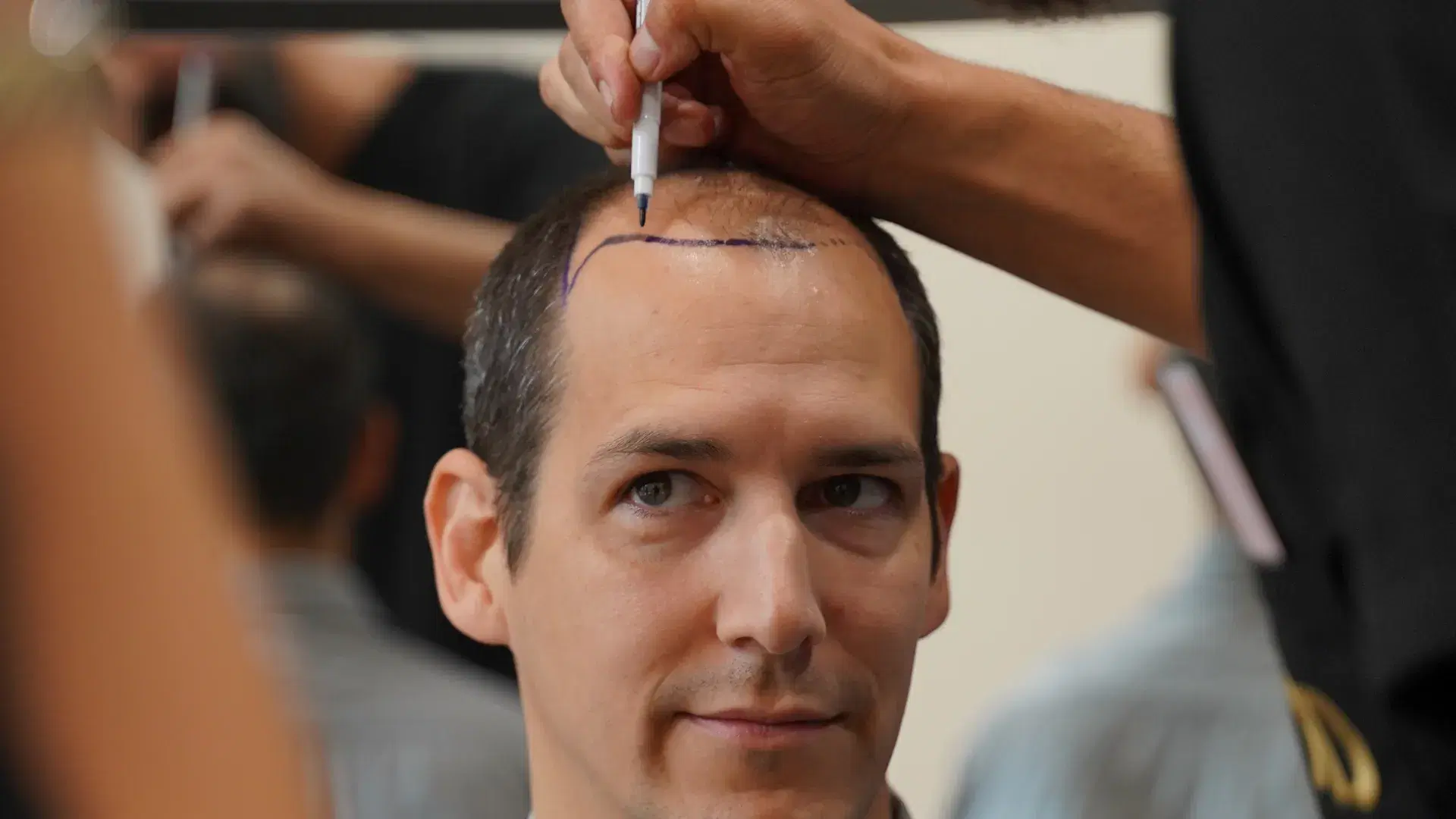 What is The Best Age For a Hair Transplant?