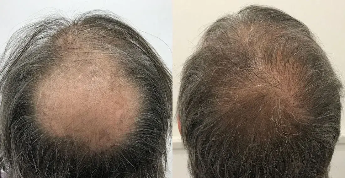 Vertex Hair Transplant
