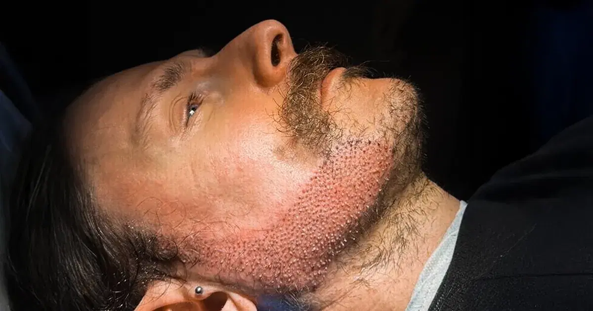 Beard Transplant