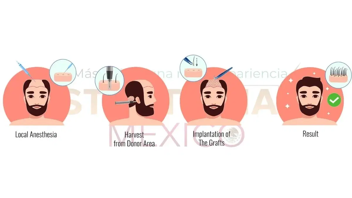 FUE Hair Transplant