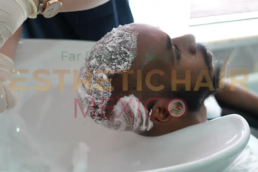 hair-wash-after-hair-transplant