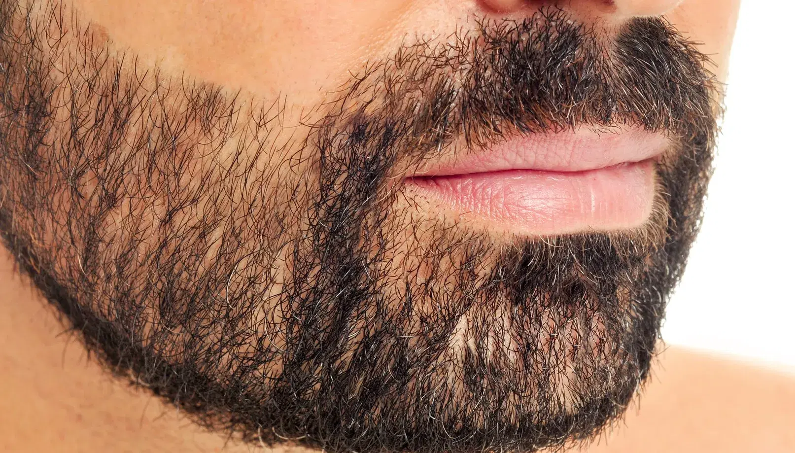 Beard Hair Improve a Weak Donor Area