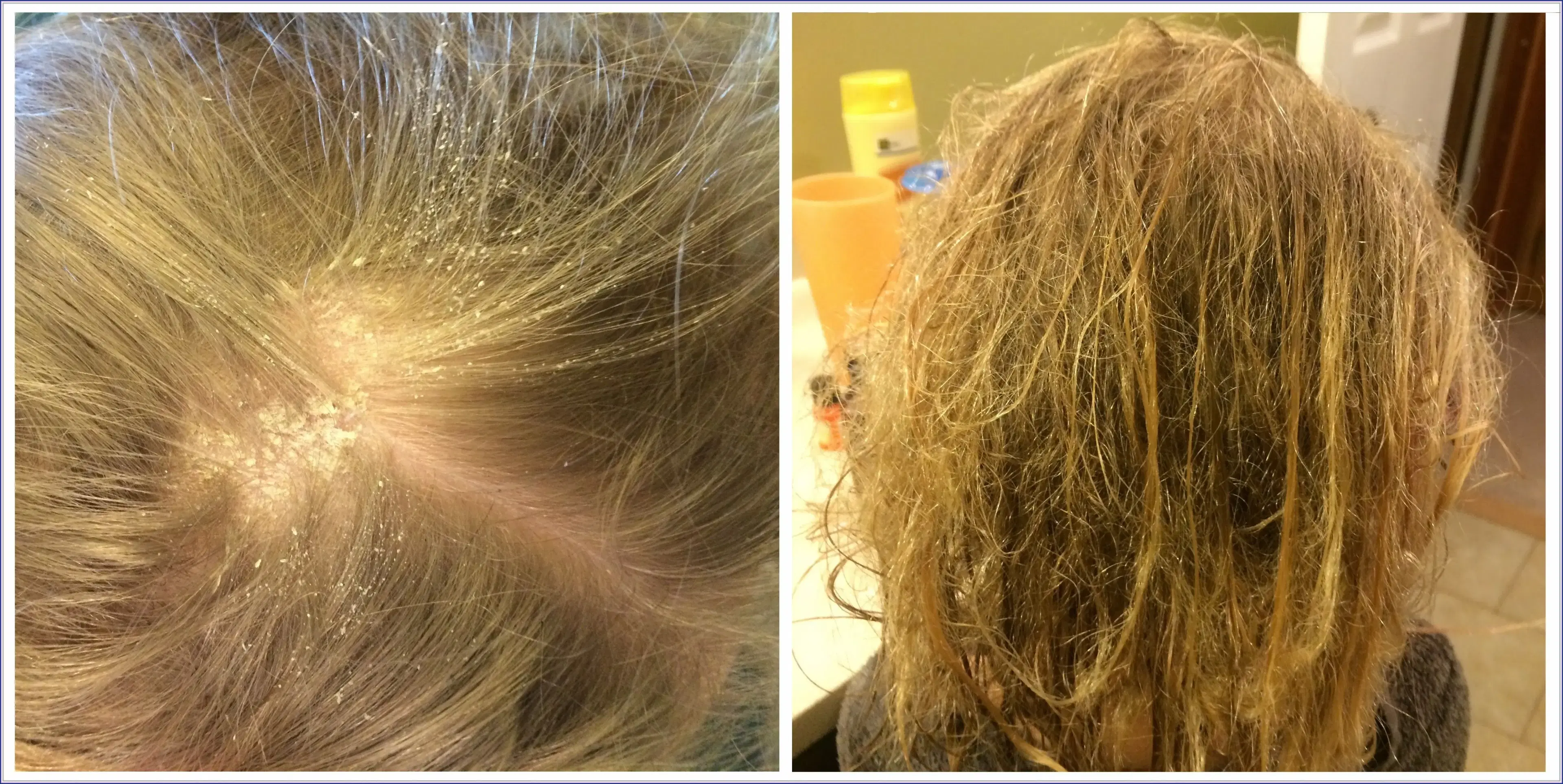 Cloro y pérdida de cabello: ¿Puede el agua de la piscina hacer que tu cabello se vuelva más delgado?