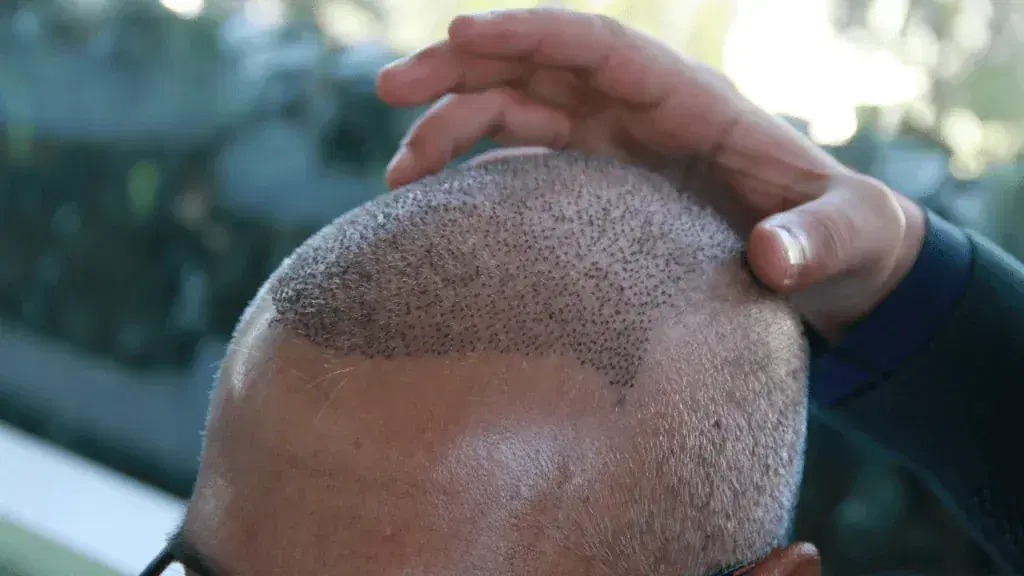 Hair Transplant Recovery in Cancun’s Heat