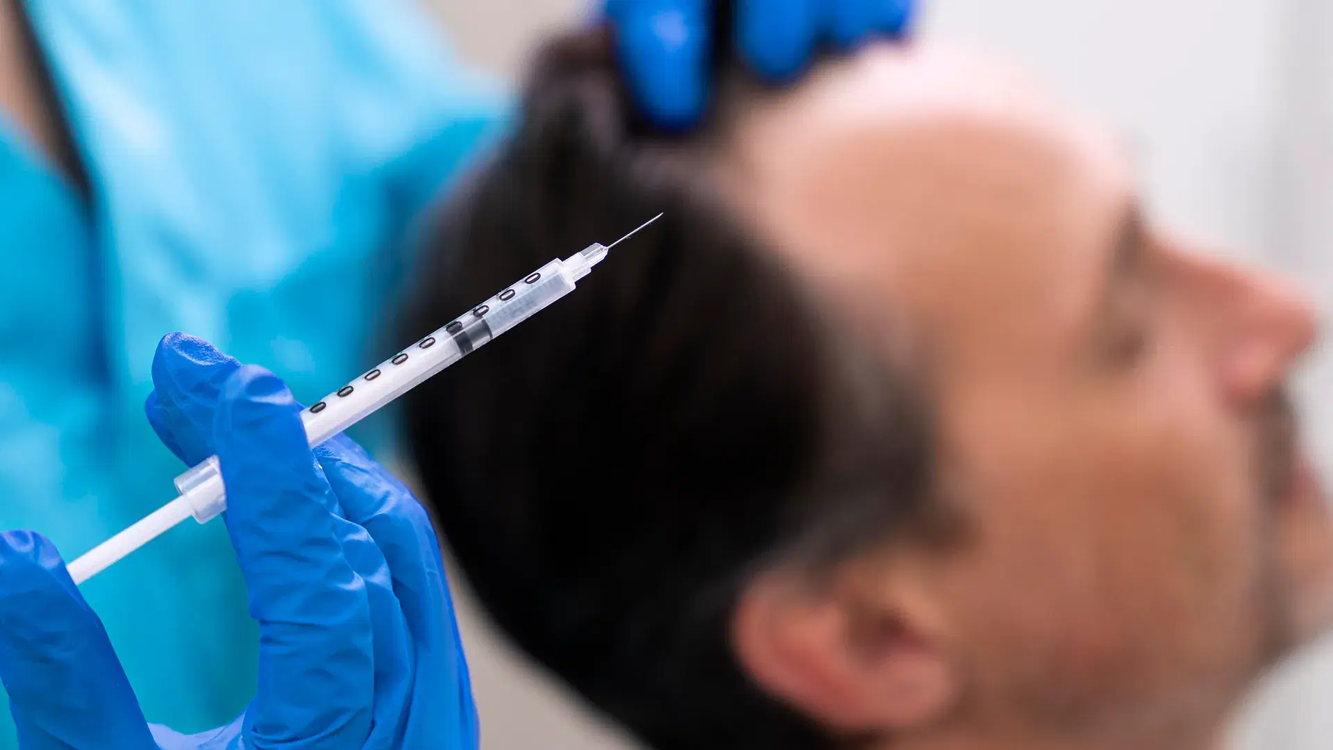 Beneficios de la Mesoterapia Capilar