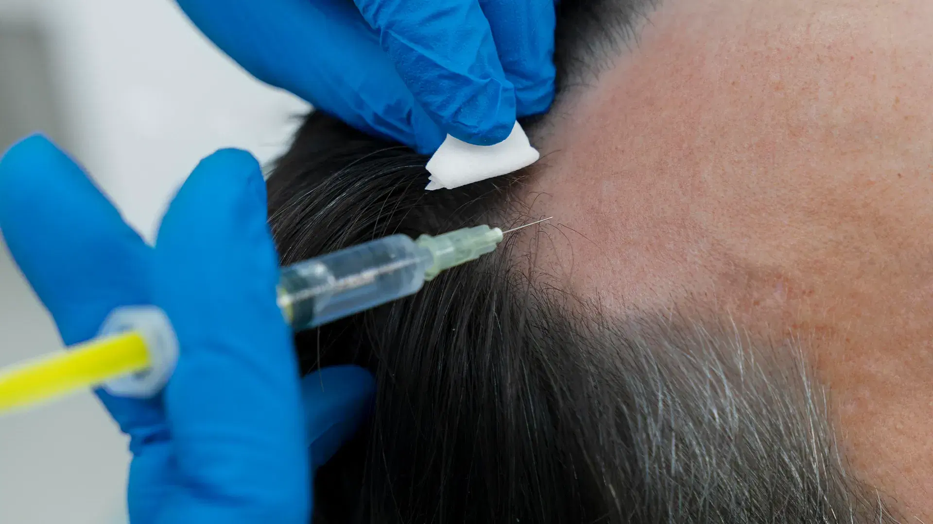Terapia con Células Madre para la Pérdida de Cabello