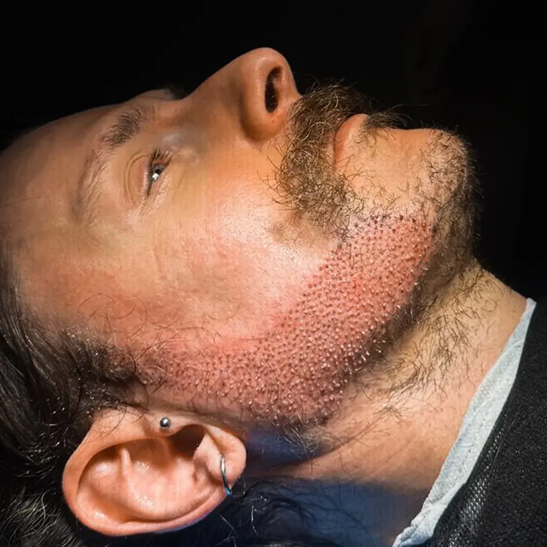 Trasplante de Barba